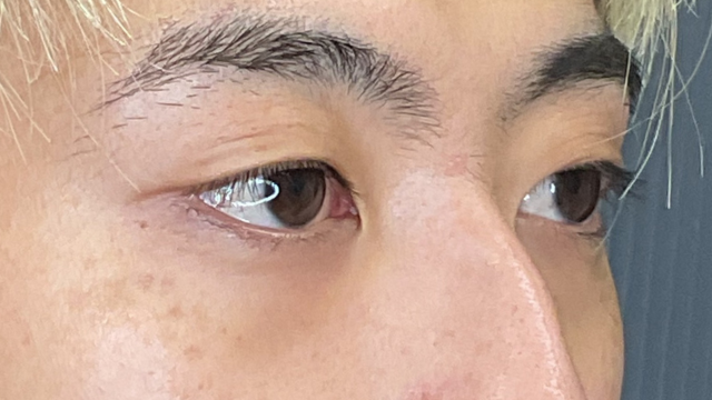 手术前的状态 其一