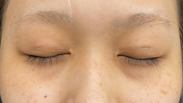 手术前的状态 其一