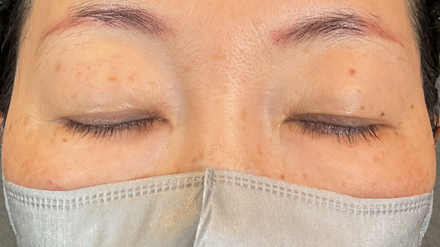 手術前の状態 その1