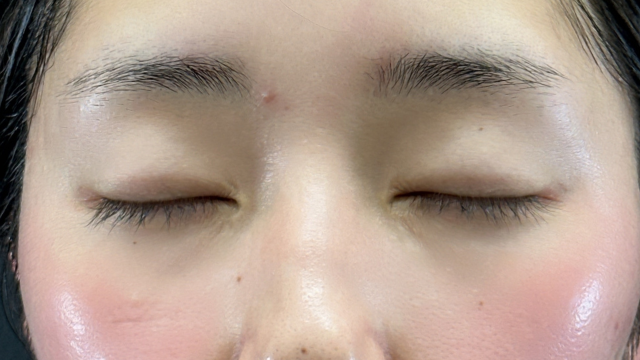 手術前の状態 その1