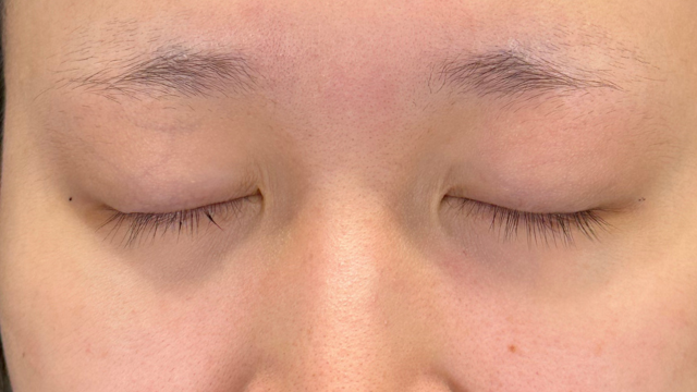 手术前的状态 其一