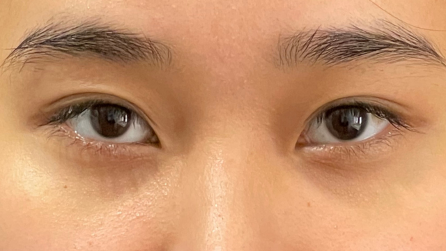 手術前の状態 その1