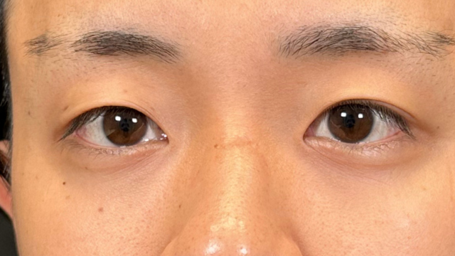 手术前的状态 其一