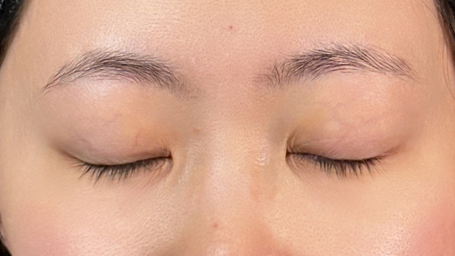 手術前の状態 その1