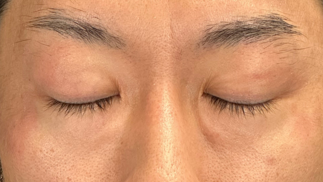 手术前的状态 其一