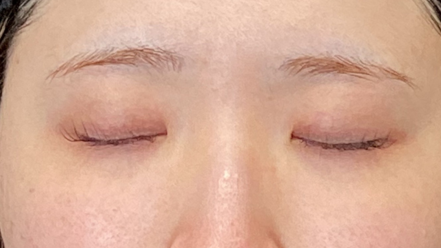 手術前の状態 その1