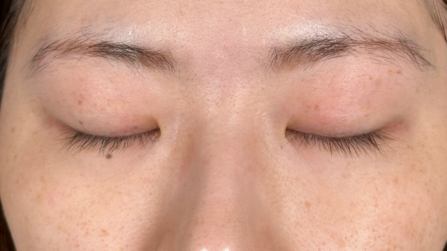 手术前的状态 其一