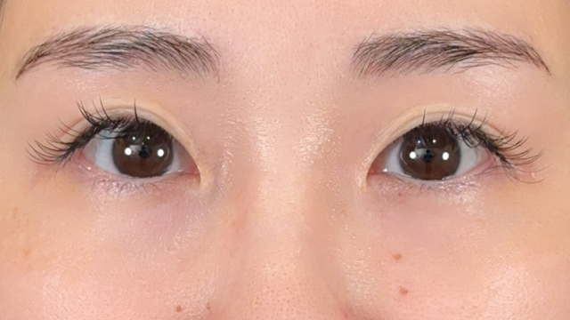 手術前の状態 その1