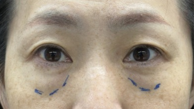 手术前的状态 其一