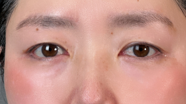 手術前の状態 その1