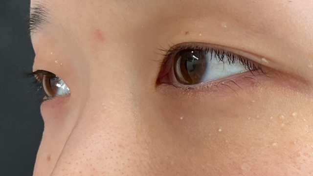 手術前の状態 その1