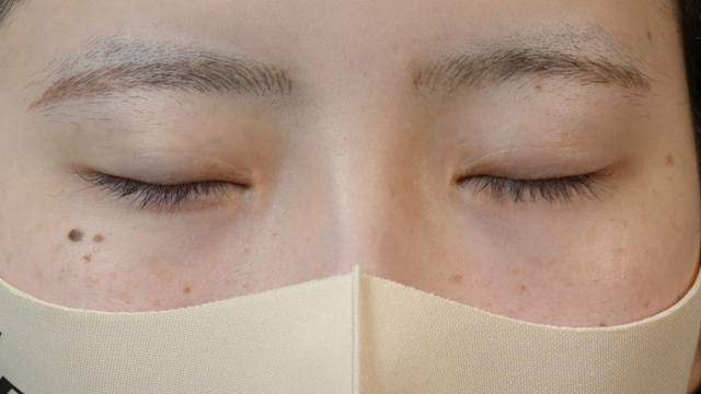 手術前の状態 その1