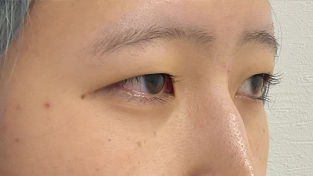 手術前の状態 その1