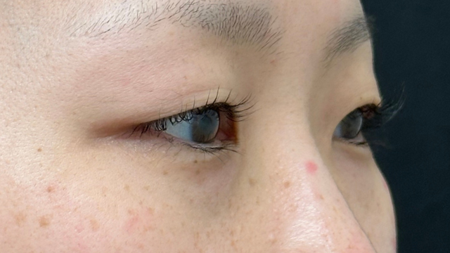 手术前的状态 其一