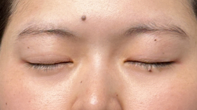 手术前的状态 其一