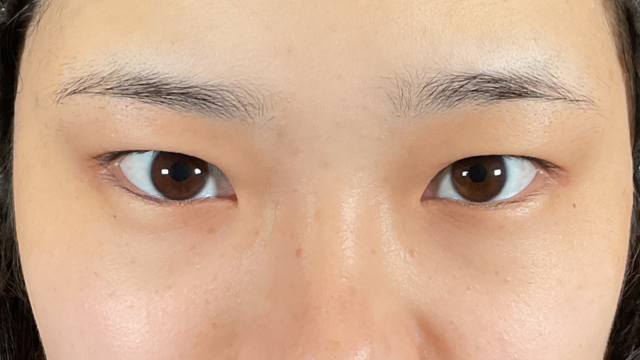 手术前的状态 其一