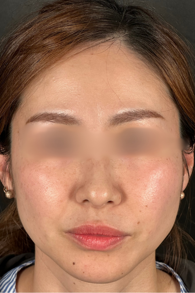 手术前的状态 其一