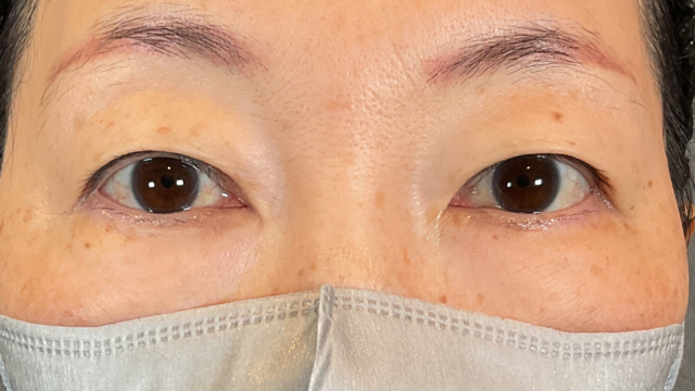 手術前の状態 その1