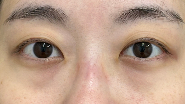 手术前的状态 其一