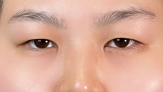 手术前的状态 其一