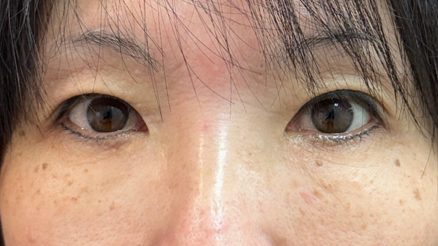 手術前の状態 その1