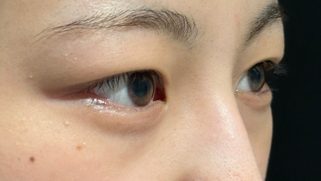 手術前の状態 その1