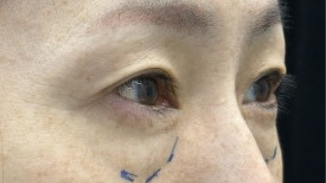 手术前的状态 其一