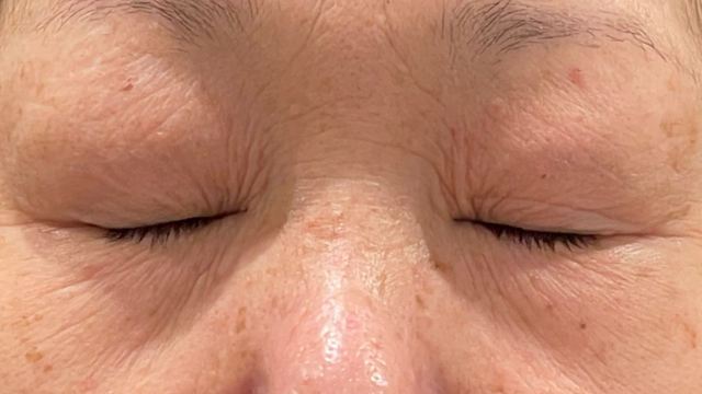 手术前的状态 其一