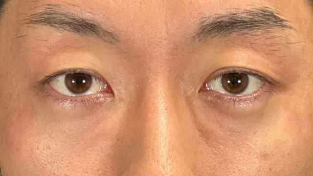 手术前的状态 其一