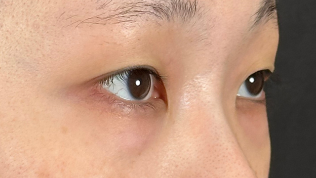 手术前的状态 其一