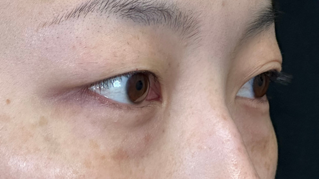 手术前的状态 其一