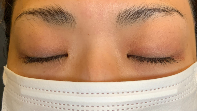 手術前の状態 その1