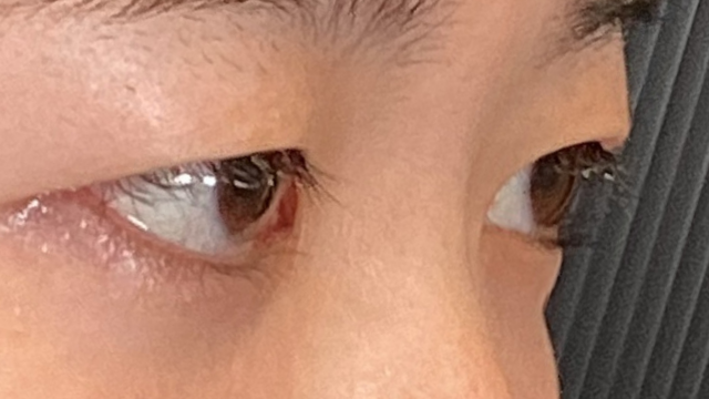 手术前的状态 其一