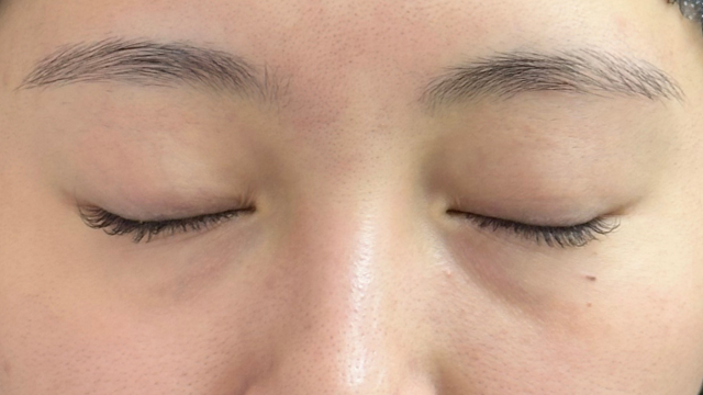 手术前的状态 其一