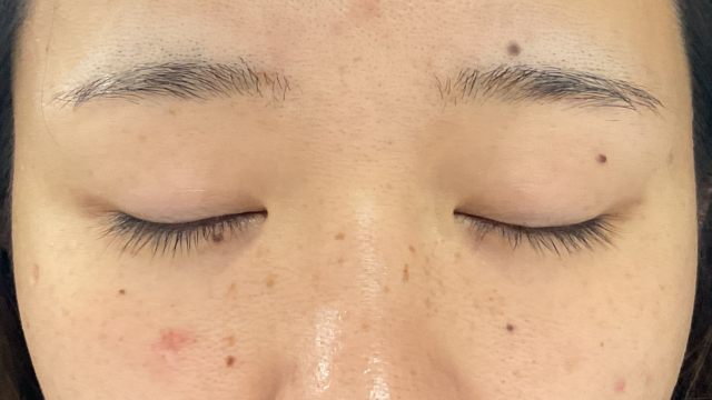 手术前的状态 其一