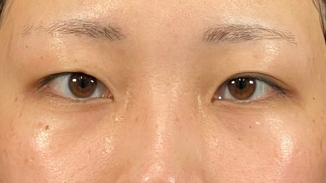 手術前の状態 その1