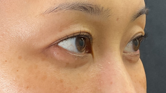 手术前的状态 其一