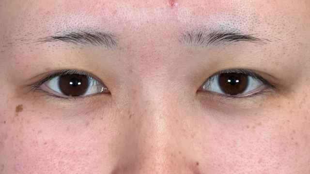 手術前の状態 その1