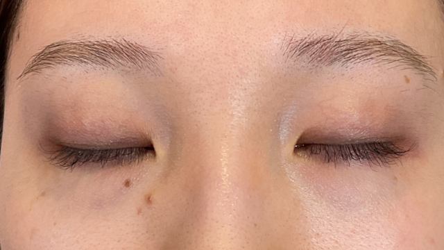 手術前の状態 その1