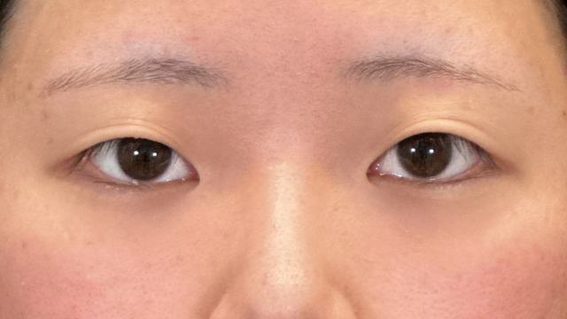 手術前の状態 その1