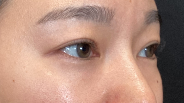 手術前の状態 その1