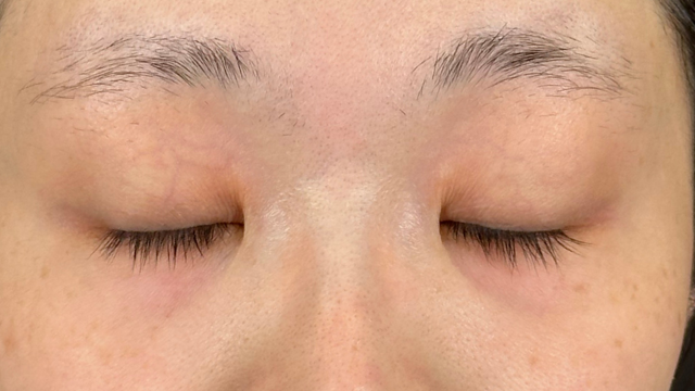 手术前的状态 其一