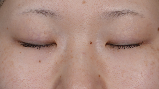 手术前的状态 其一