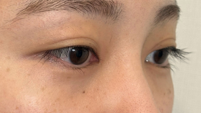 手术前的状态 其一