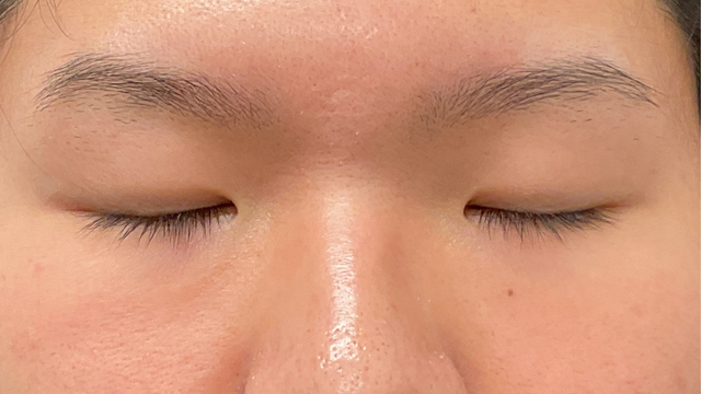 手術前の状態 その1