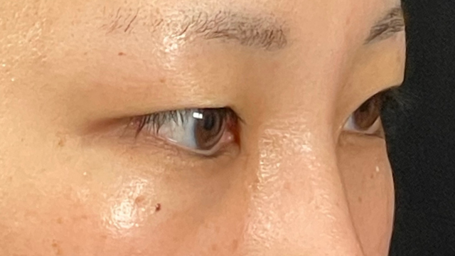 手術前の状態 その1