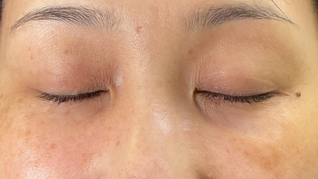 手术前的状态 其一