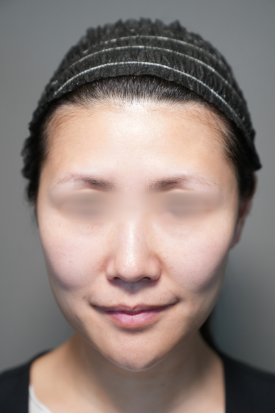 手術前の状態 その1