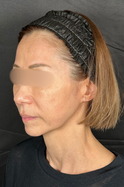 手術前の状態 その1