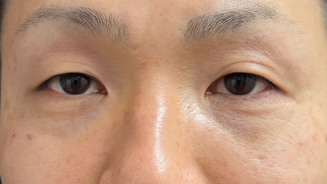 手术前的状态 其一